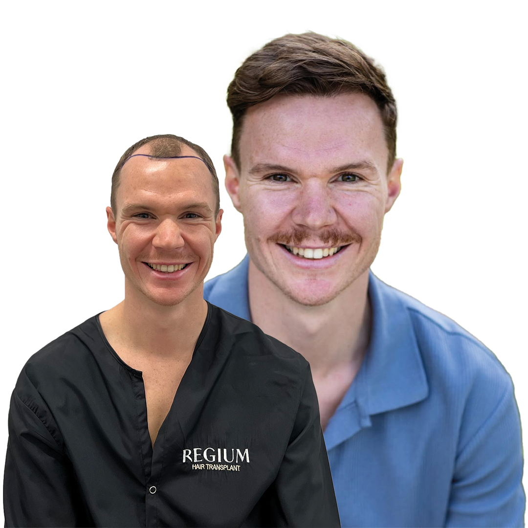 Regium Hair Transplant Result